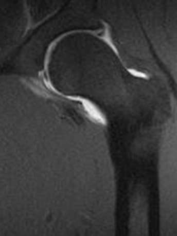 Arthrogram Mri