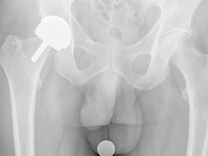 Resurfacing Hip Arthroplasty. with a hip resurfacing